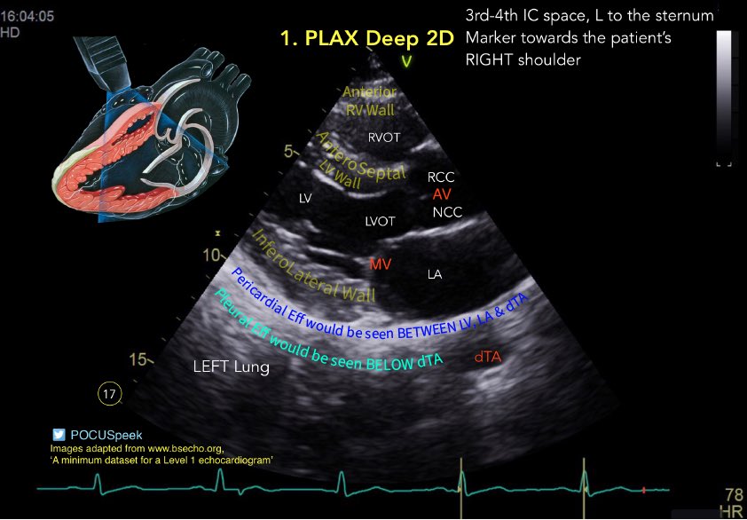 POCUSpeek's tweet image. Learning #POCUS &amp;amp; Illustrator. #firstecho PLAX Deep 2D view. @pocusfoamed #MedEd #MedTwitter