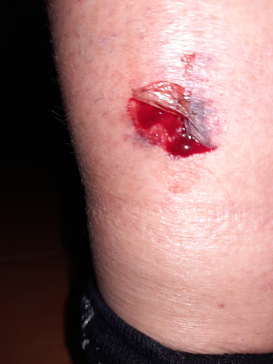 Absolutely disgusted as the way I was treated. Bus number 419. Floor way to high to board at the terminus. Fell flat on the floor and suffered this injury. I'm in absolute agony and the bus driver couldn't give a toss. <a href="/NCT_Buses/">Nottingham City Transport</a> you are the worst