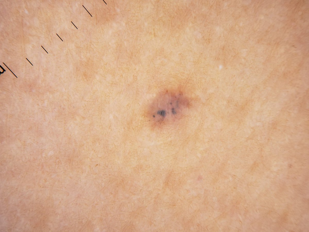 DrCristianMD's tweet photo. Traumatic tattoos can mimic pigmented BCCs!

In this article, we describe the characteristics of these BCC mimickers -- traumatic tattoos should be included in the differential diagnosis of BCC 

@AbarzuaAlvaro @IDS_Dermoscopy 
#dermoscopy #dermatoscopy 

https://t.co/VgkpfsJaWo https://t.co/TxhrNiVCq2