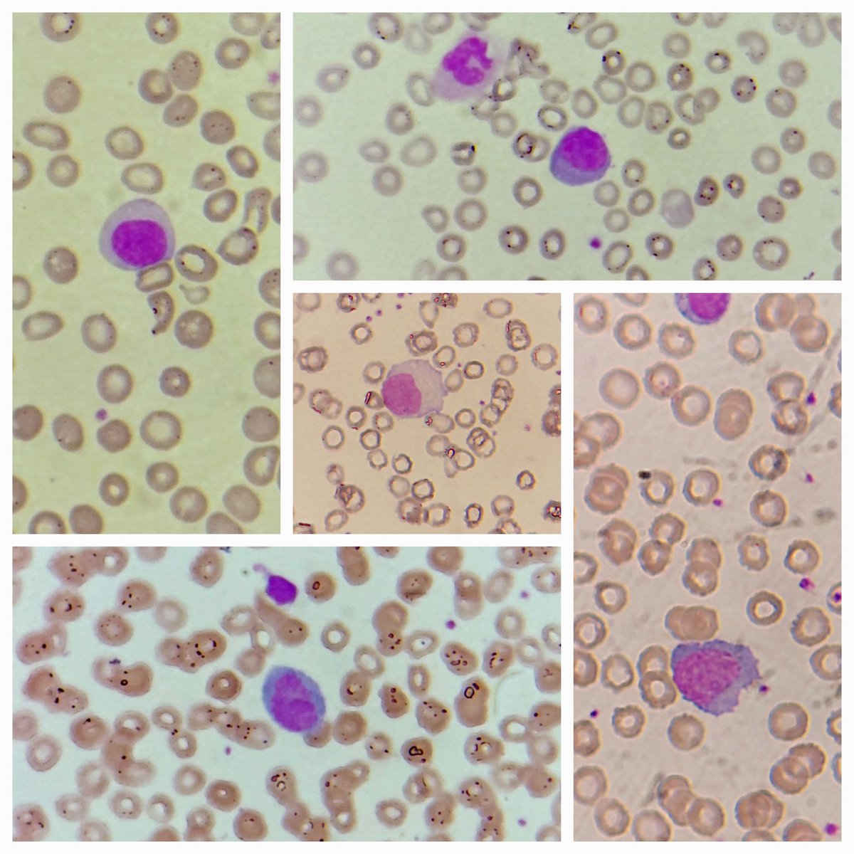 padmapathology1's tweet image. A few reactive and plasmacytoid lymphocytes. History of fever, a couple dengue positive. #hemepath #PathTwitter #IDpath
