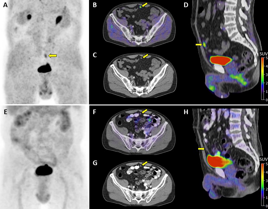 Peter Maliha provides a rare, illustrated post: A pitfall for FAPi imaging. ow.ly/Ztim50MizWU

#NuclearMedicine #MolecularImaging #Cancer #JNuclMed <a href="/CalaisJeremie/">Jeremie Calais</a>