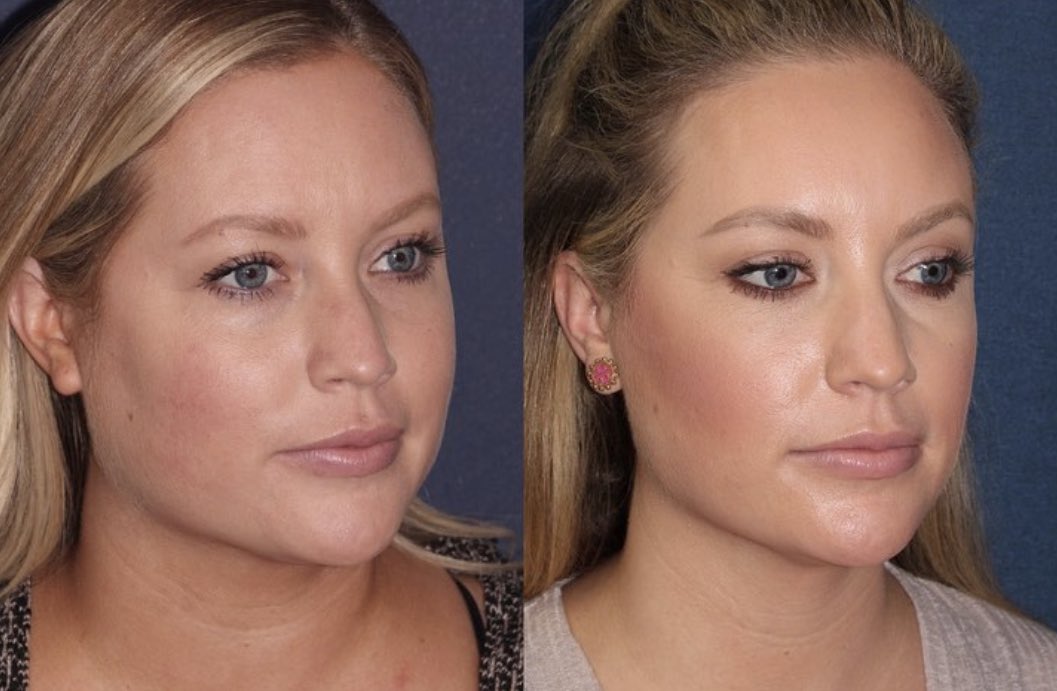 TheCosmeticLane's tweet photo. Buccal fat this, buccal fat that.. Sometimes, not all lower face heaviness is comprised of fat. 

It can be caused by masseter muscle hypertrophy, which was true in this patient’s case. Neuromodulators were used to treat her masseter which slimmed down her lower face &amp; neck https://t.co/24SLJ6abH6