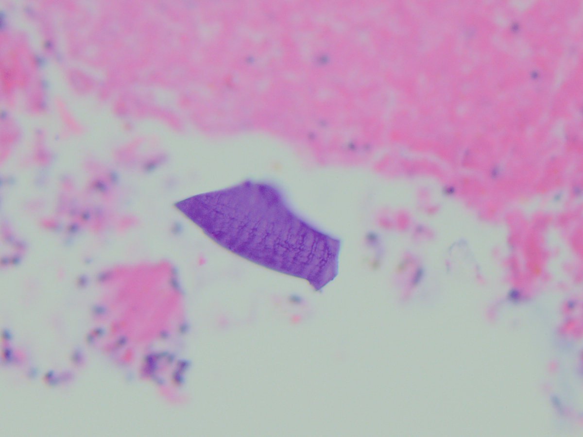 Jerad Gardner, MD on Twitter "RT smlungpathguy Kayexalate (sodium