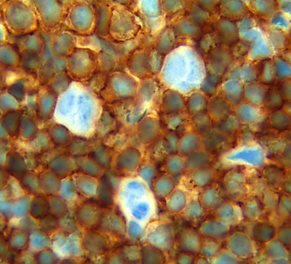 AmritPSinghMD's tweet photo. Did you know Nodular Lymphocyte Predominant Hodgkin Lymphoma has recently been renamed by the ICC as nodular lymphocyte predominant B cell lymphoma? This rare form of lymphoma is characterized by the presence of T-cell rosettes around neoplastic LP cells #NLPHL #hemepath https://t.co/koHqlb0bUA