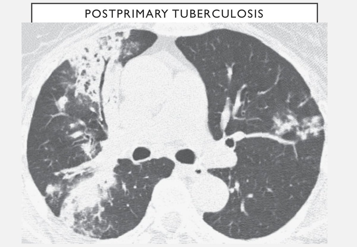 Postprimary TB typical features of significant Tree in bud combined with consolidation or cavitation in typical upper lobe & superior segment of lower lobe distribution is mostly suggestive. Differentials including fungal or bacterial infection lack significant Tree in bud