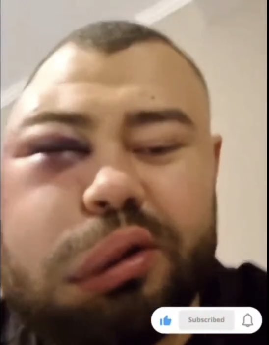 BenTheBaneDavis's tweet photo. This is the slap fighter from the viral video last week today - this is not a sport, should not be sanctioned/popularized. Shame on everyone pushing this as a legit product https://t.co/8VrYCy3lh8