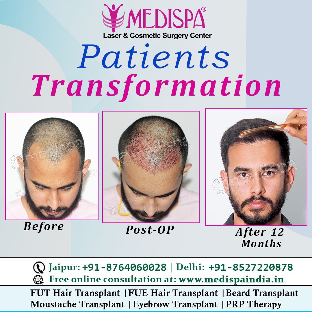 MedispaHairTransplantCenter (@medispajaipur) / Twitter MedispaHairTransplantCenter (@medispajaipur) / Twitter