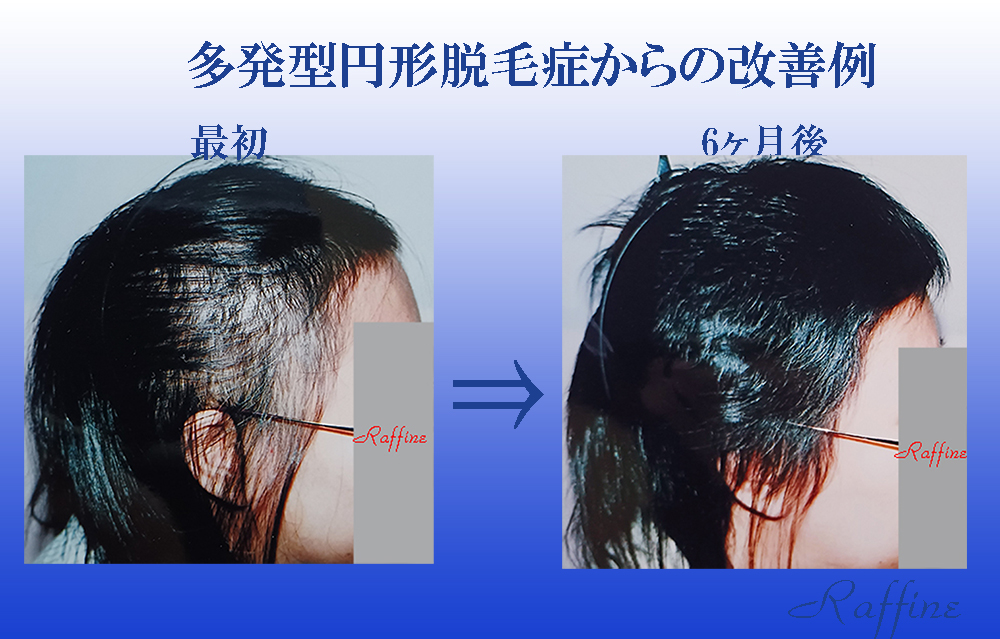 増毛 病気脱毛 シート 状 植毛 ブラウン 増毛 【公式通販】