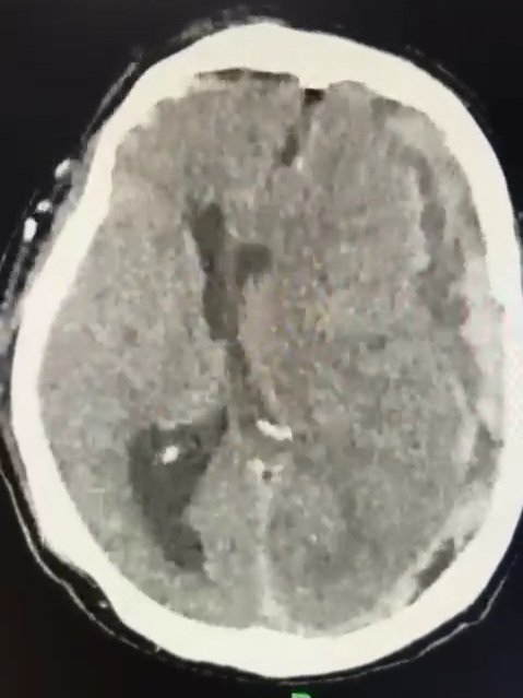 drtintin99's tweet photo. Here's a dilemma for our #MorningPaper readers. Young man with this #ASDH due to heparin for his biventricular extracorporeal cardiac circuit (pending heart transplant). GCS 12. What would you do?

@neuro_at_ic @e1v1m1 @AsianCNS @realbrainbook @EANS_yns @WFNS_YNF @realyoungcaans https://t.co/XRbJ27iXHV