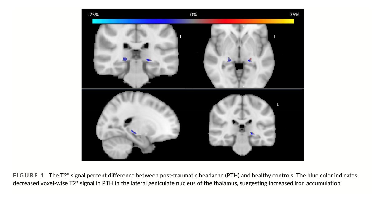 Thalamic subfield iron accumulation after acute mild #TraumaticBrainInjury (#TBI) as a marker of future post-traumatic #headache intensity @chongcd1 @visarASU @schwedtt et al …adachejournal.onlinelibrary.wiley.com/doi/10.1111/he…