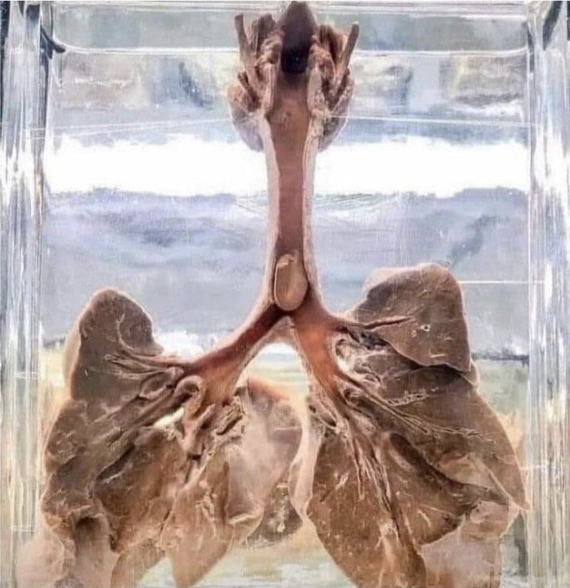 Soluk borusuna fıstık kaçması nedeniyle nefessiz kalıp ölen bir çocuğun akciğeri