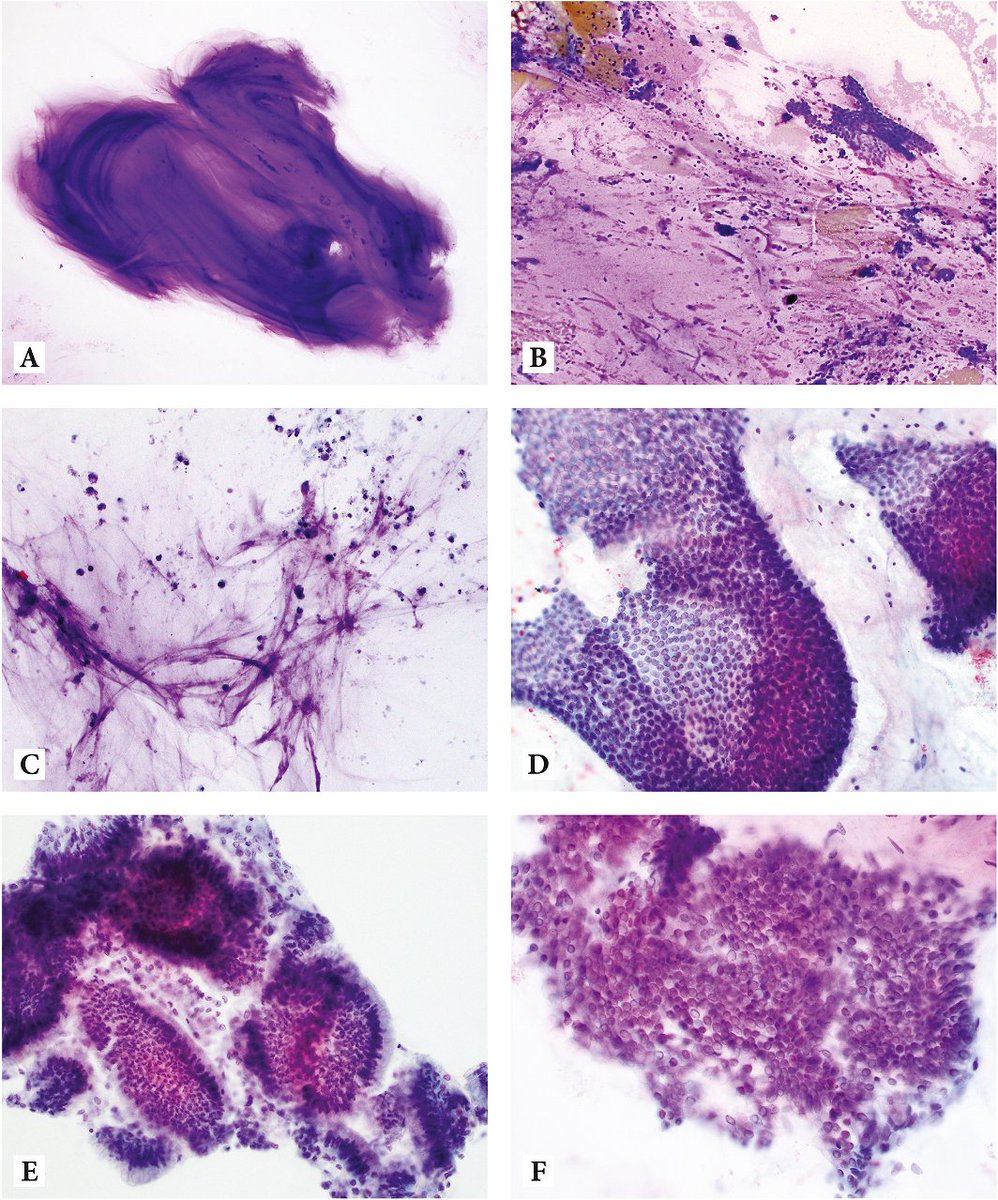 CancerCytopath's tweet photo. Just published | Diagnostic features of low- and high-grade mucinous neoplasms in pancreatic cyst FNA cytology https://t.co/cpTVKTzDQa @carliesigel @mskpathology @WCMCpathology #cytopath #endpath https://t.co/BYnsjLMdaM