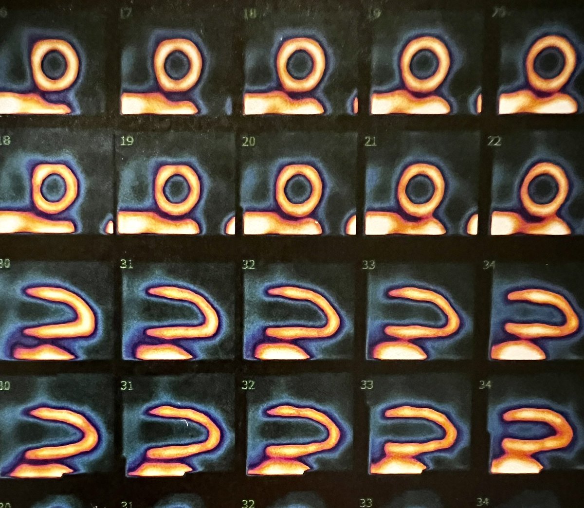 Amazing improvement of image quality after deep learning attenuation correction in D-SPECT myocardial perfusion imaging! New times coming! <a href="/WiefelsC/">Christiane Wiefels</a> <a href="/rafaelnuclear/">Rafael W Lopes</a> <a href="/nuclearsbrandao/">Simone C S Brandão</a> <a href="/RiquemexMN/">Riquemex</a> <a href="/EvangelistaI/">Laura Evangelista</a> <a href="/MyASNC/">ASNC Society</a> <a href="/DCalnon/">Dennis Calnon</a> <a href="/DorbalaSharmila/">Sharmila Dorbala</a> #CardioTwitter #ArtificialIntelligence