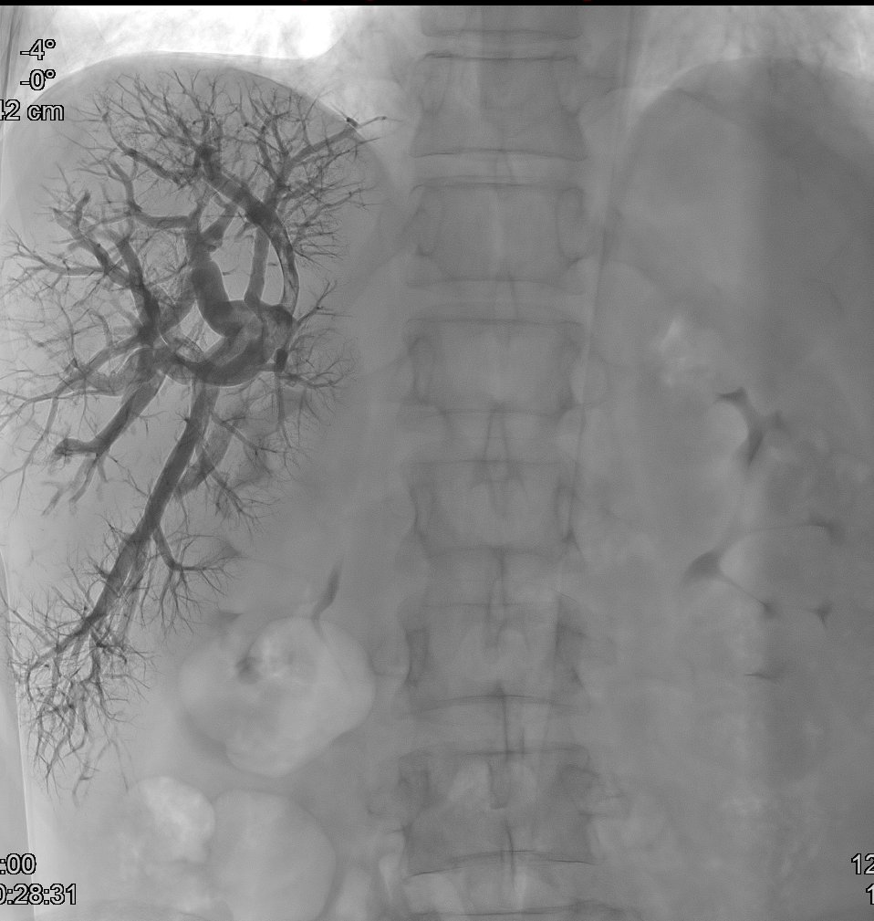 Embolización porta derecha.
Introductor 8Fr. Fogarty 5.5Fr.
Glue+Lipiodol 1:4 (22cc).
23 minutos.