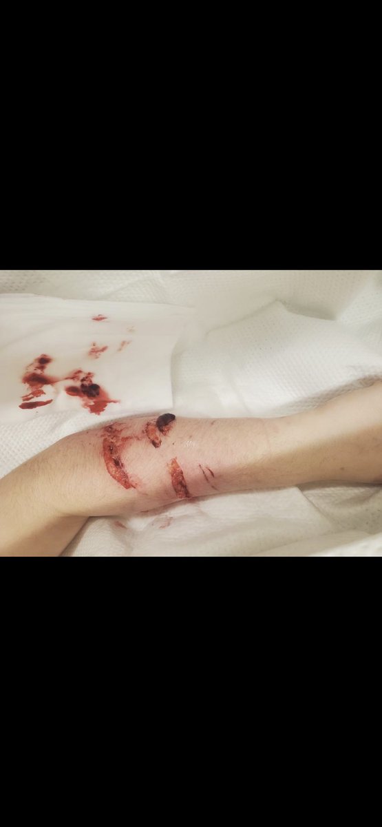 WillowBergman7's tweet photo. @Little_Luee I was just attacked by one. I almost lost my life. We believe he was jealous I was pregnant https://t.co/7DOFchBs67