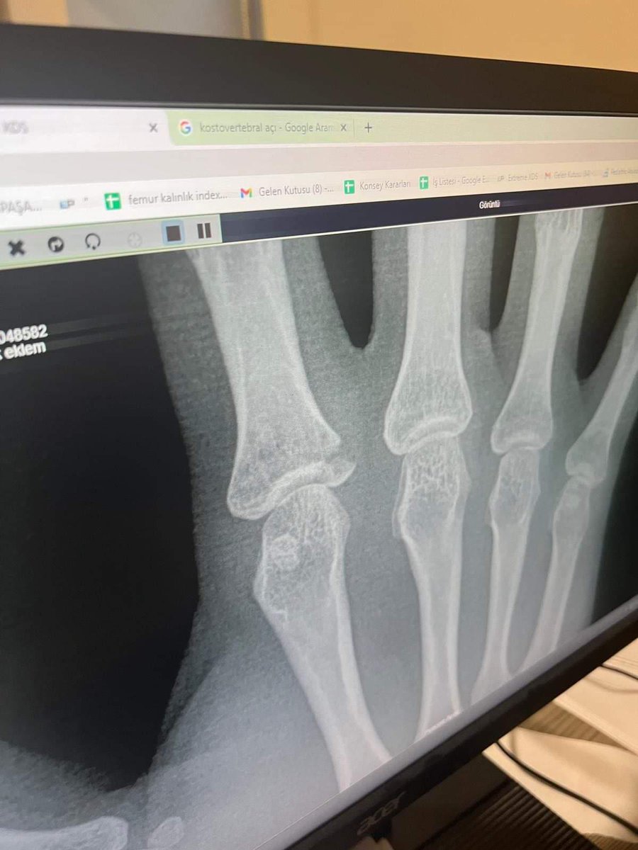DrYukselmis's tweet photo. İşi gücü bırakın. Hekime şiddet var
Bir cerrahı daha elinden yaraladılar.

GOP KBB'de asistan doktor hanımın proksimal falanksı kırıldı

Aylarca amelyat yapamayacak Meslektaşımızın yanındayız. 
Bize uzanan eller kırılmadıkça daha çok böyle saçmalıklar göreceğiz. https://t.co/vvjvo1LAC9