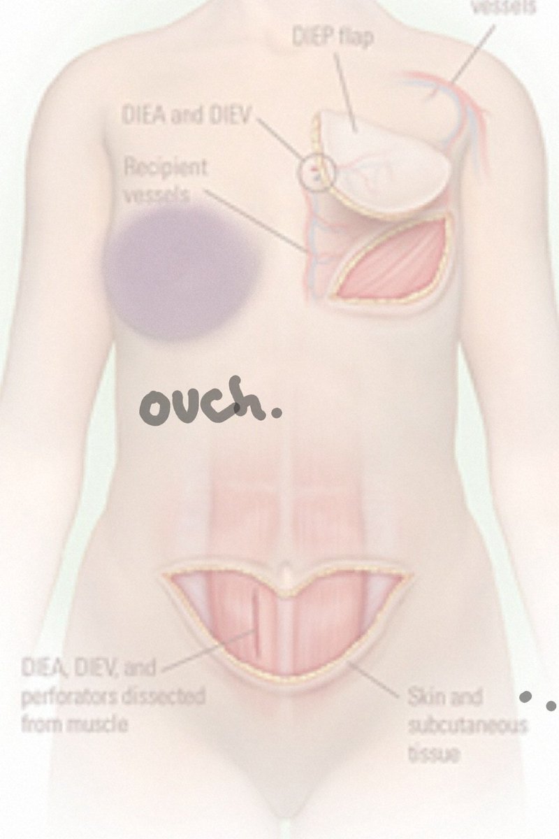 avetcpa's tweet photo. Surgeon called yesterday. There was a cancelation, so I could have the build a boob 10 hour surgery on February 7th, instead of in June.  During tax season. When I'm still waiting to see the results of  kidney surgery. Yeah nope nope nope. #TaxTwitter #diepflapsurgery https://t.co/gMF7F1GHlJ