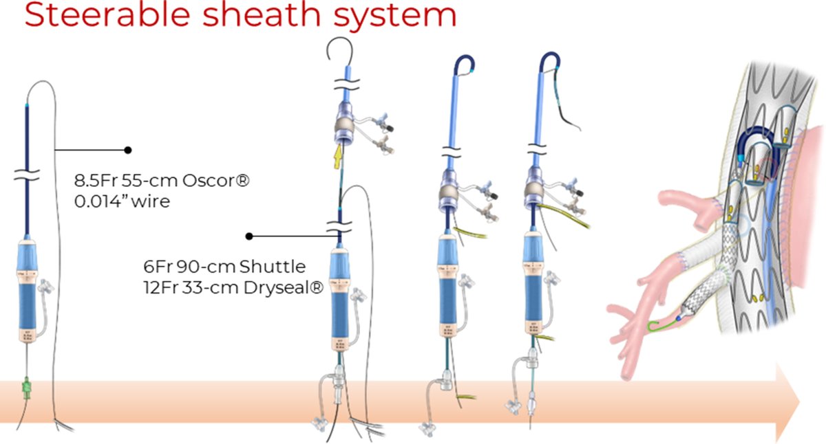 Marina Dias Neto (@m_diasneto) on Twitter photo Details of the "Endovascular repair of intercostal patch aneurysms in a patient with Loyes-Dietz syndrome"
Read the paper here: doi.org/10.1016/j.jvsc…
#aorticresearch #vascularsurgery #endovascularsugery <a href="/GustavoOderich/">Gustavo Oderich</a> <a href="/GBarbosalima/">Guilherme B. Barbosa-Lima</a> Details of the "Endovascular repair of intercostal patch aneurysms in a patient with Loyes-Dietz syndrome"
Read the paper here: doi.org/10.1016/j.jvsc…
#aorticresearch #vascularsurgery #endovascularsugery <a href="/GustavoOderich/">Gustavo Oderich</a> <a href="/GBarbosalima/">Guilherme B. Barbosa-Lima</a>