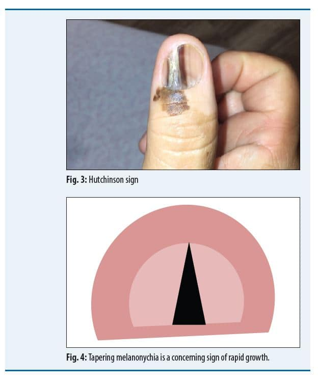 DermTech: Rule Out Melanoma with Precision Genomics