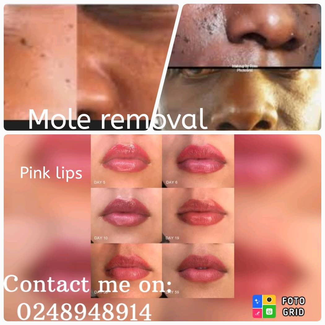 KDuah20's tweet photo. Contact Evey on 0248948914 for your stretch marks removal, mole removal and pink lips at affordable prices. https://t.co/7Xc0YSKdLR