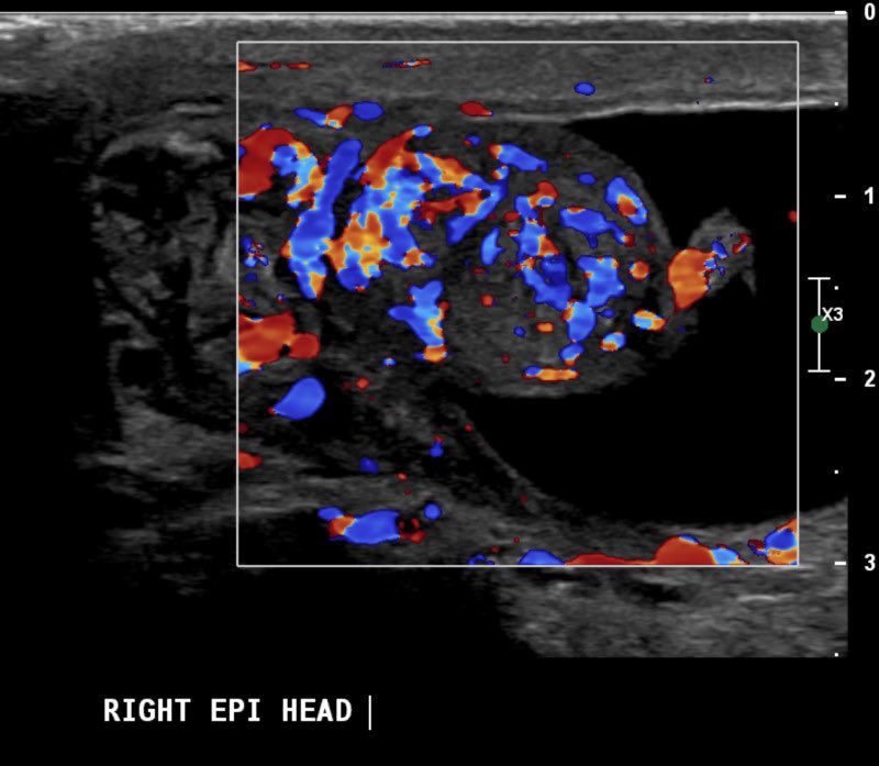 radsharenet's tweet photo. What is your level of confidence that this is epididymo-orchitis? Answer in GIF. #foamrad #foamed #radres https://t.co/DSbqZ0F70P