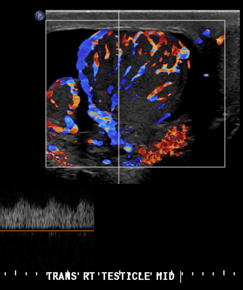 radsharenet's tweet photo. What is your level of confidence that this is epididymo-orchitis? Answer in GIF. #foamrad #foamed #radres https://t.co/DSbqZ0F70P