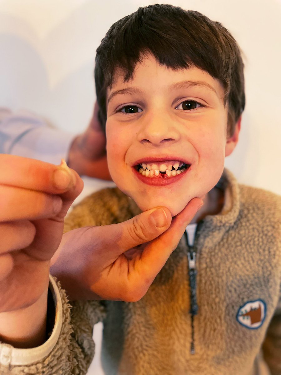 Medtweeps, hoe groot is de kans op osteomyelitis als je een tand uittrekt met school-vuil-pollen?