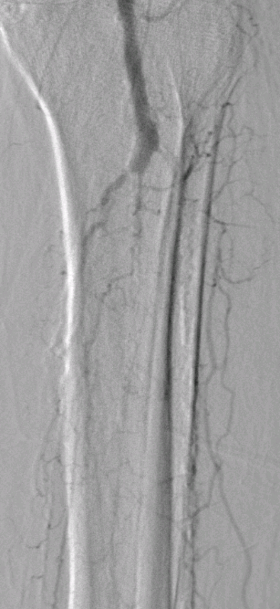 jalilka87's tweet photo. #rutherford stage 6, previous failed #revascularization. CTO PTA/ATA/peroneal. Thru-N-Thru access from DPA-ACA-peroneal--R-CFA. Palpable DP pulse with strong CPA doppler. @FadiSaab17 @_MCLIN_ @AMPSymposium #endovascular #PAD #gangrene #flossing #navicross @AuryonPad https://t.co/KObiQtDWVR