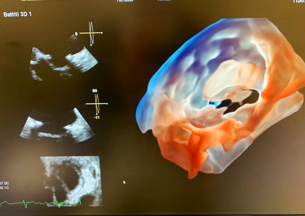 De novo acute severe mitral regurgitation in a patient with a repaired mitral valve with Alfieri's tecnique in 1992. 
Sometimes the answer is on the other side. #echofirst #tee #3D #glassview