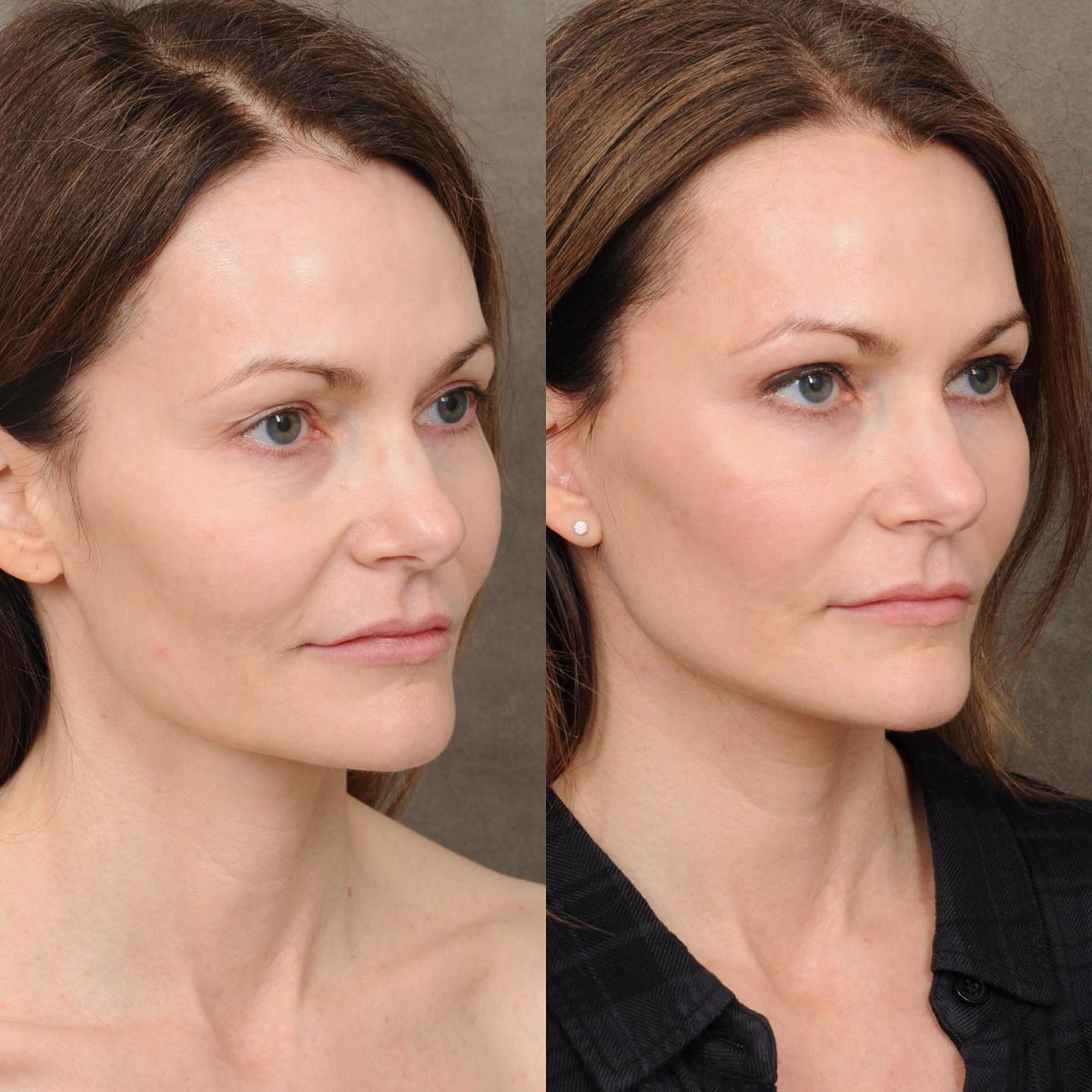 DrBenTalei's tweet photo. The simplest #AuraLyft cleanup on such a pretty and sweet face. We are 3 months out from AuraLyft with minor fat grafting to improve the under-eye projection as well as #upperBleph to freshen the upper lids. Natural, nice and fresh! https://t.co/0S898FfCuU