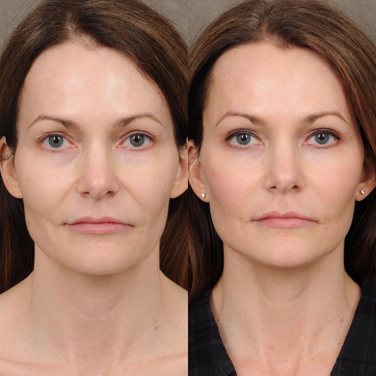 DrBenTalei's tweet photo. The simplest #AuraLyft cleanup on such a pretty and sweet face. We are 3 months out from AuraLyft with minor fat grafting to improve the under-eye projection as well as #upperBleph to freshen the upper lids. Natural, nice and fresh! https://t.co/0S898FfCuU