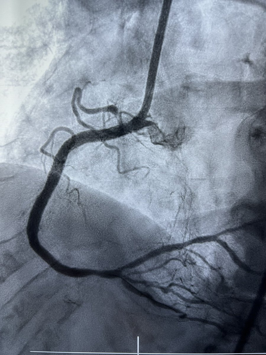 Lorenzo Azzalini (@lazzalinimd) on Twitter photo Great team of women in intervention #WIC <a href="/WomenAs1/">Women As One</a> performing a complex case <a href="/UWCathLab/">UW Med Cath Lab</a> <a href="/UWMedHeart/">UWashington Heart Institute</a> — great job <a href="/JTiwanaMD/">Jasleen Tiwana</a>, Dr. Pristera & Molly Great team of women in intervention #WIC <a href="/WomenAs1/">Women As One</a> performing a complex case <a href="/UWCathLab/">UW Med Cath Lab</a> <a href="/UWMedHeart/">UWashington Heart Institute</a> — great job <a href="/JTiwanaMD/">Jasleen Tiwana</a>, Dr. Pristera & Molly