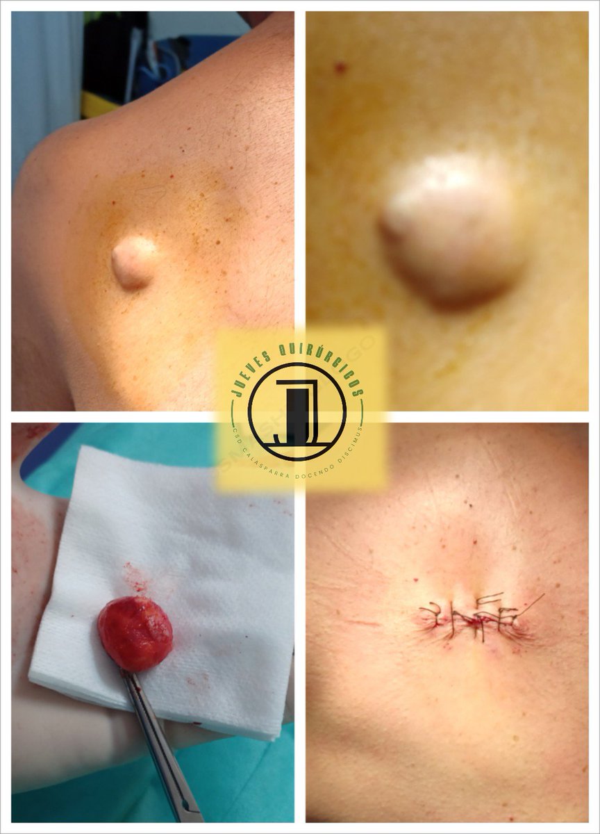 CCalasparra's tweet photo. Nueva Edición de nuestros Jueves Quirúrgicos.  Absceso glúteo, quistes retroauricular y dorsal , y lipoma periarticular en codo.@ #docendodiscimus @Area4Noroeste @smumfyc @Murciasalud @UsuariosanidadM @poncelorenzo1 @IsabelAyalaVig @CS_SanAnton https://t.co/CZpUtnofUy