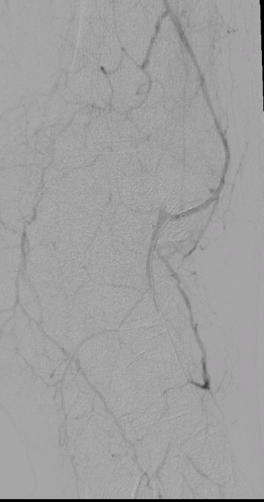 jalilka87's tweet photo. #rutherford stage 6, previous failed #revascularization. CTO PTA/ATA/peroneal. Thru-N-Thru access from DPA-ACA-peroneal--R-CFA. Palpable DP pulse with strong CPA doppler. @FadiSaab17 @_MCLIN_ @AMPSymposium #endovascular #PAD #gangrene #flossing #navicross @AuryonPad https://t.co/KObiQtDWVR
