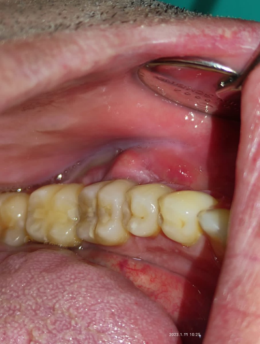 yayamejiassosa's tweet photo. Pac: 5 am me despierta con dolor insoportable,va a consulta y me encuentro con esto. 
Yo: receto antibiótico combinado y le digo, hay que realizar endodoncia.  
Pac.: a los dos días, NO ME HARE NADA PORQUE YA NO ESTA INFLAMADO.  
Yo: Perfecto -jo da se- https://t.co/2Oh83s1zOF
