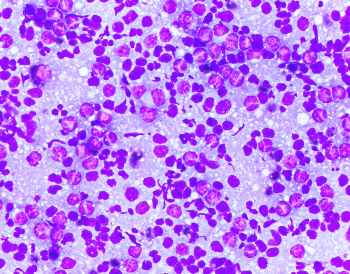 HubertLauMD's tweet image. Wow, I haven&apos;t posted anything in a long time.

Here are some CLASSIC cleaved cells of follicular lymphoma.

I personally find it easier to appreciate the cleaved morphology on air-dried cytology smears than on H&amp;amp;E. What do you think? #HemePath #CytoPath #FNAPath