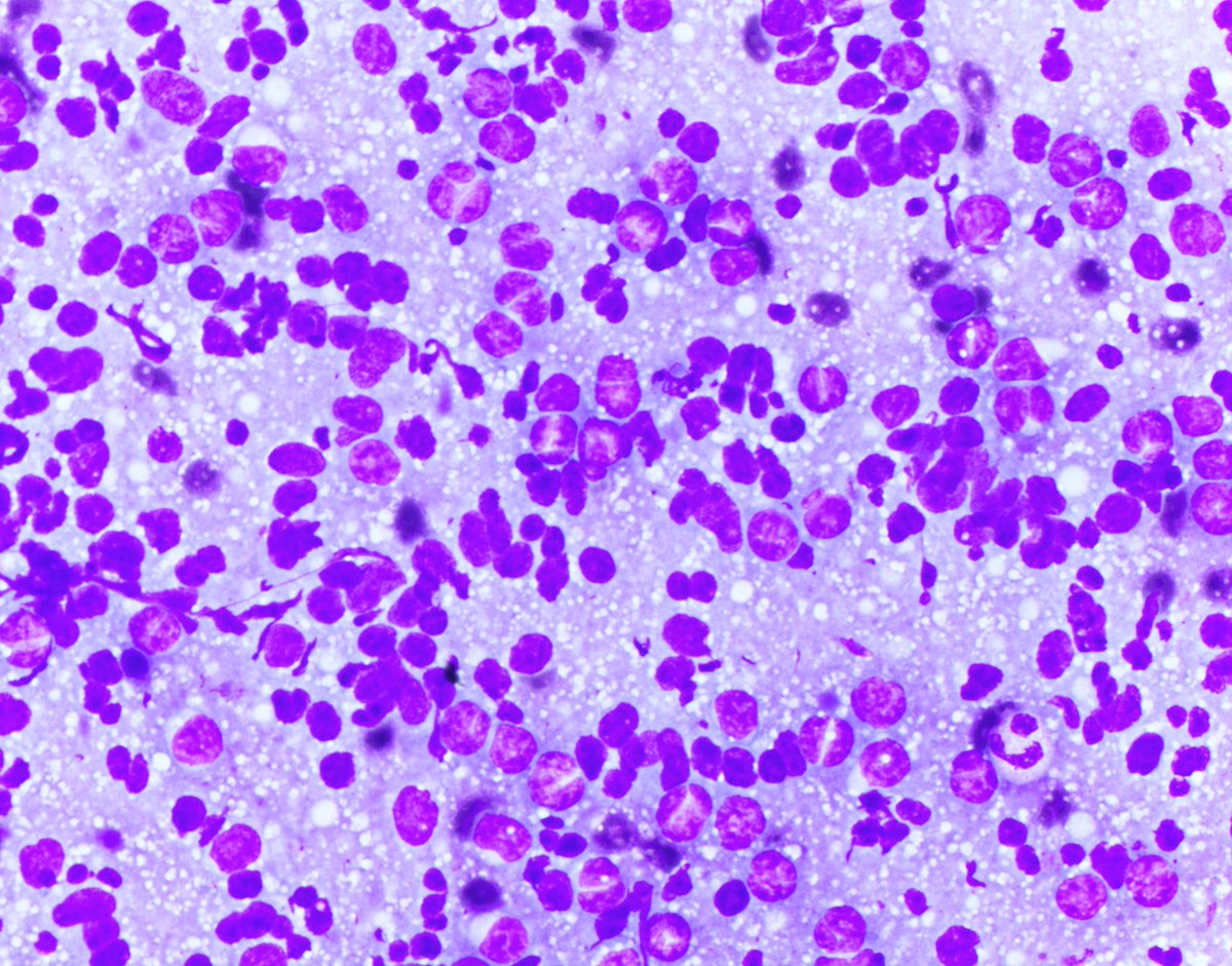 HubertLauMD's tweet image. Wow, I haven&apos;t posted anything in a long time.

Here are some CLASSIC cleaved cells of follicular lymphoma.

I personally find it easier to appreciate the cleaved morphology on air-dried cytology smears than on H&amp;amp;E. What do you think? #HemePath #CytoPath #FNAPath