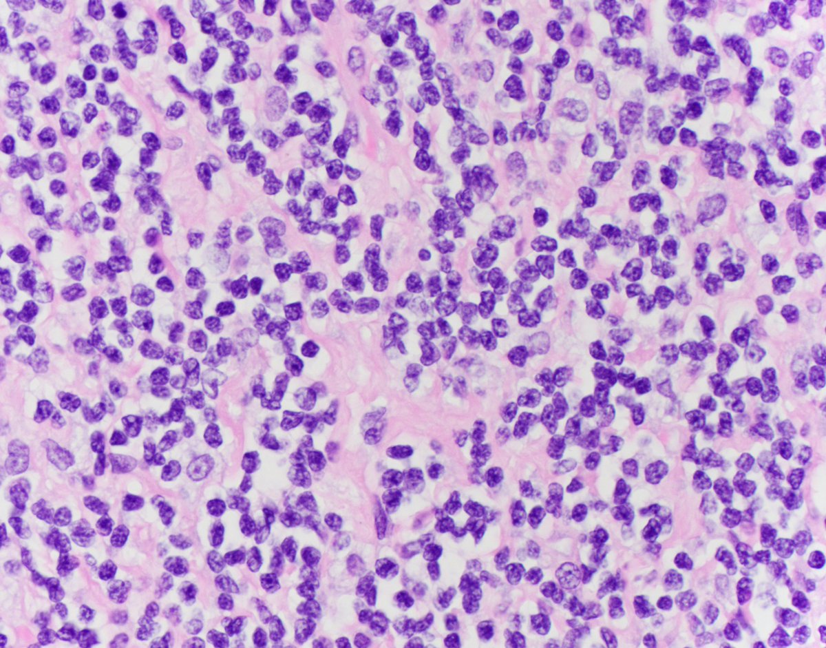 HubertLauMD's tweet image. Wow, I haven&apos;t posted anything in a long time.

Here are some CLASSIC cleaved cells of follicular lymphoma.

I personally find it easier to appreciate the cleaved morphology on air-dried cytology smears than on H&amp;amp;E. What do you think? #HemePath #CytoPath #FNAPath