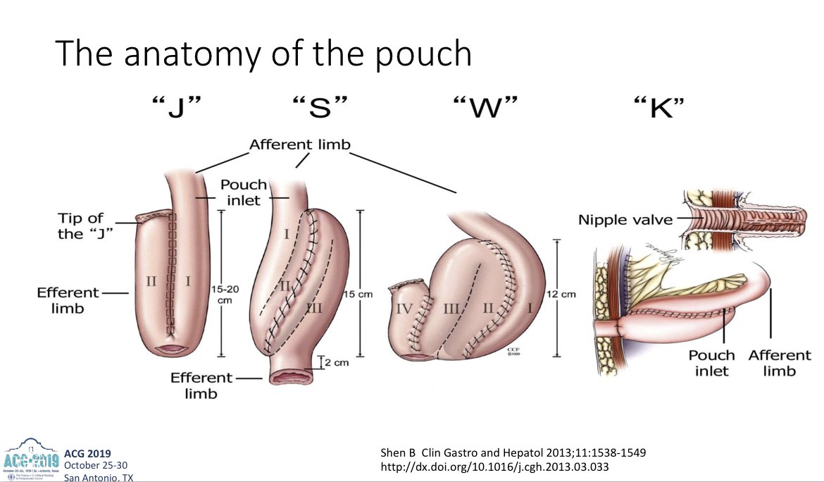 CarlKayMD's tweet image. Pouch Review from @LauraRaffalsMD at #ACG2019

▪️Pouch anatomy (J, S, W, K)
▪️Endoscopic landmarks of J
▪️Pouch complications DDx
▪️Treatment algorithm for pouchitis

#GITwitter #IBD