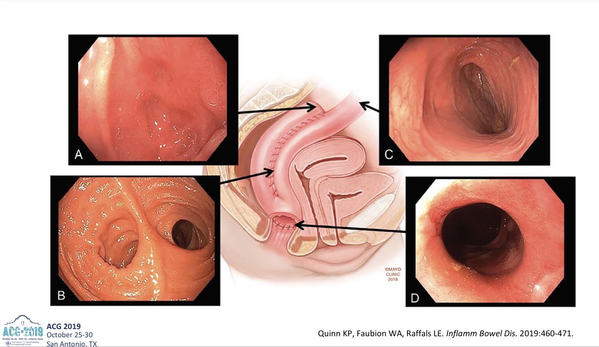 CarlKayMD's tweet image. Pouch Review from @LauraRaffalsMD at #ACG2019

▪️Pouch anatomy (J, S, W, K)
▪️Endoscopic landmarks of J
▪️Pouch complications DDx
▪️Treatment algorithm for pouchitis

#GITwitter #IBD