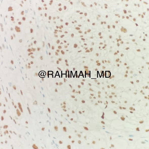 Rahimah_MD's tweet photo. 4, post fossa tumour, Brachyury = CHORDOMA #BSTPathology https://t.co/QS7g1RndOg