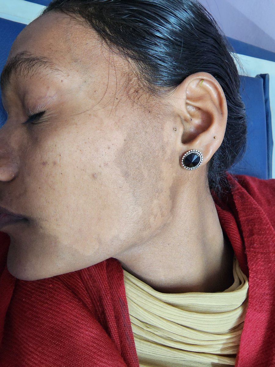 ArunInamadar's tweet photo. Spotter 58: clue .... since birth depigmentation https://t.co/jMK8hSu5KH