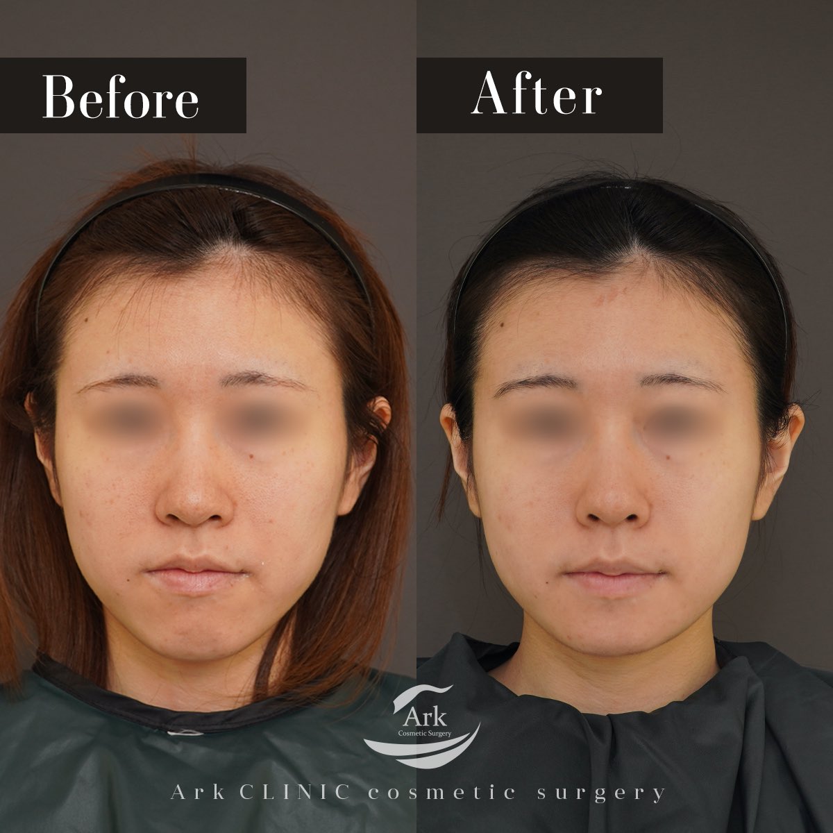ark_clinic's tweet photo. ミニVライン形成（オトガイ形成＋外板除去）の術後1年です。3mm中抜きして、4mm前方に出しました。顎を短くすると顎に丸みがでて柔らかい印象になります。
短くしつつシャープにしたいという方は、
エラ骨切りを組み合わせると良いです。 https://t.co/hHDugkRcKL
