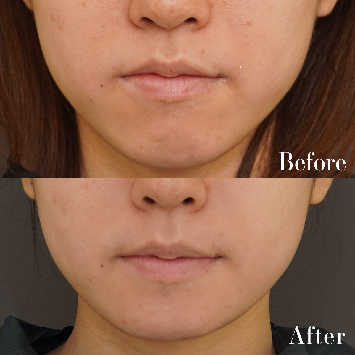 ark_clinic's tweet photo. ミニVライン形成（オトガイ形成＋外板除去）の術後1年です。3mm中抜きして、4mm前方に出しました。顎を短くすると顎に丸みがでて柔らかい印象になります。
短くしつつシャープにしたいという方は、
エラ骨切りを組み合わせると良いです。 https://t.co/hHDugkRcKL