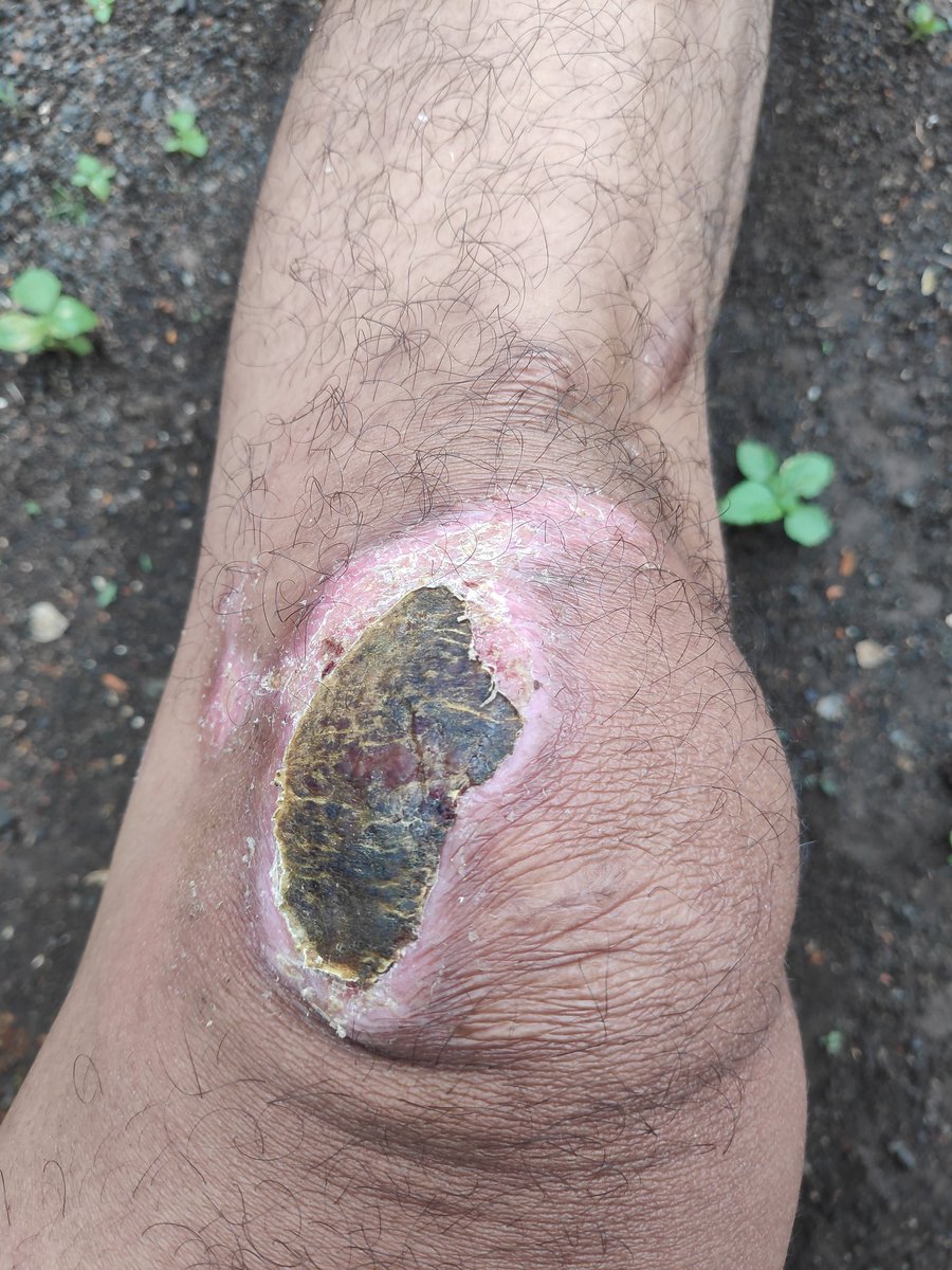 Hari ke 13 luka udah mulai kering dan bisa di kelopekin sebagian