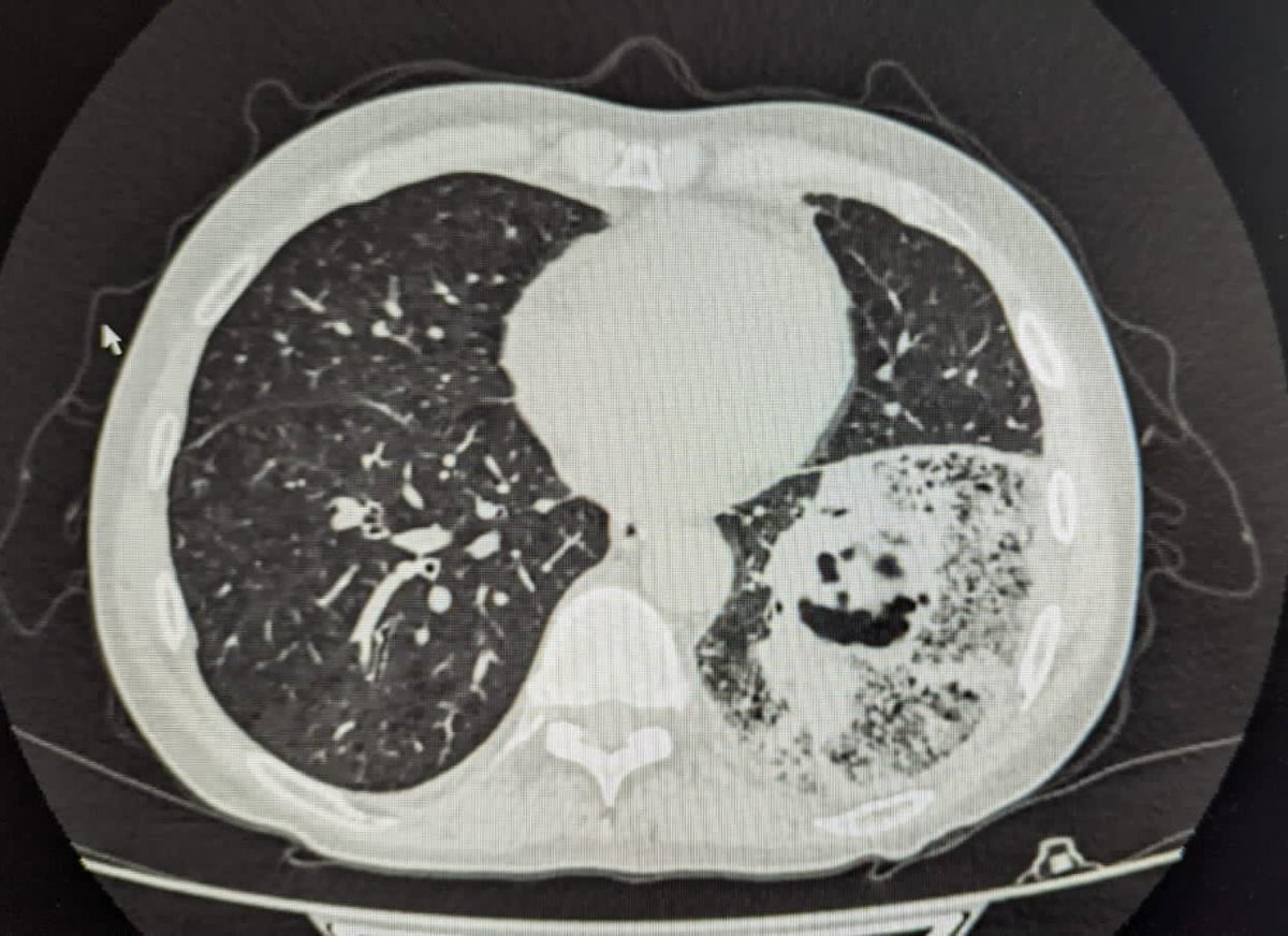 drvigen's tweet photo. Grouchy ureteric stent and cheerful pneumonia. Forwarded to me by radiologist. 
#medicalvisuals https://t.co/Itp4GXLoTW
