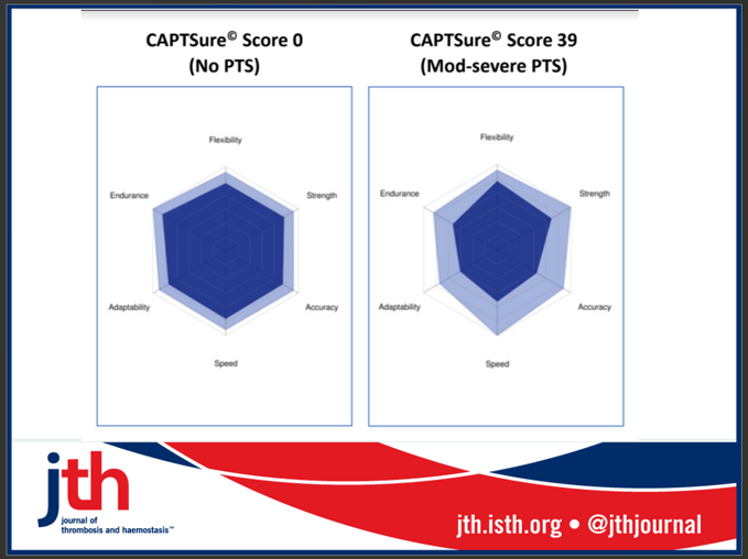 JTHjournal's tweet photo. In this prospective pediatric study: ⬆️PTS severity, as per CAPTSure© scores  ▶️📈movement restrictions, measured using MAM-CAT &amp; impaired mobility, measured using PROMIS-PF. Example of MAM-CAT plots for 2 patients ➕/➖PTS. @DeniseBastas @Didascalias_TO https://t.co/ZBCnSIzrzN https://t.co/skG7UPb4nX