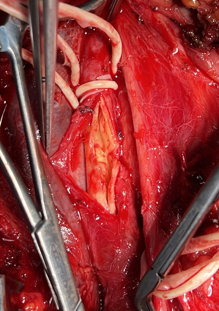 px201407's tweet photo. carotid artery dissection https://t.co/f0CooK3dxG