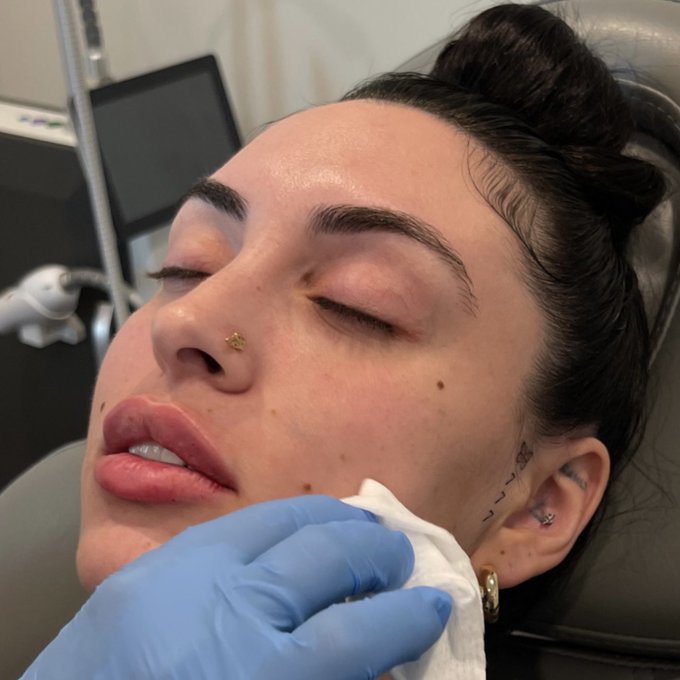 1 pic. Got my second round of lipfiller & I just wanted to show how mf pretty they are🥰 https://t.co
