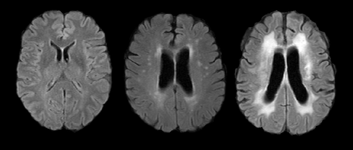 Relacionan cómo nuestros hábitos de vida influyen en el envejecimiento del #cerebro 🧠

Un estudio liderado en el @IMIM_research por <a href="/JimBrain9/">JimBrain</a> i <a href="/Joan_Balado/">Joan Jiménez Balado</a> demuestra su relación con la #edadbiológica de cada persona

bit.ly/Envejecimiento… <a href="/NEUVAS1/">NEUVAS-IMIM</a> <a href="/Biology_MDPI/">Biology MDPI</a> #ictus